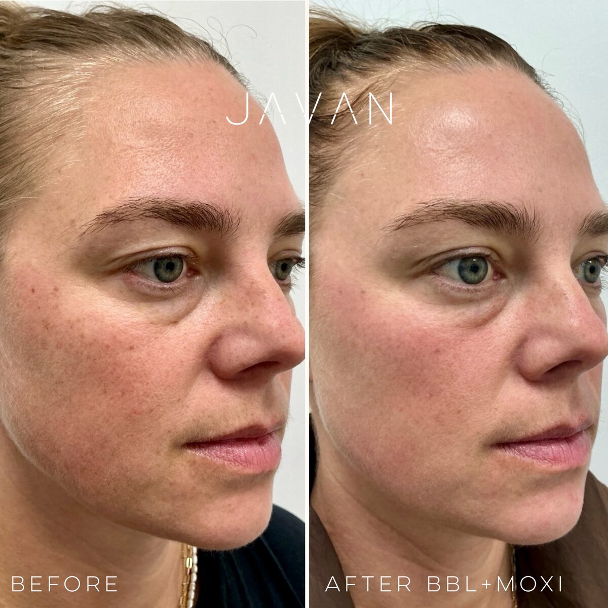 BBL and MOXI laser before and after