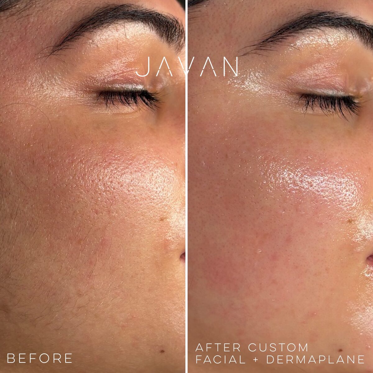 Custom Facial and Dermaplane before and after