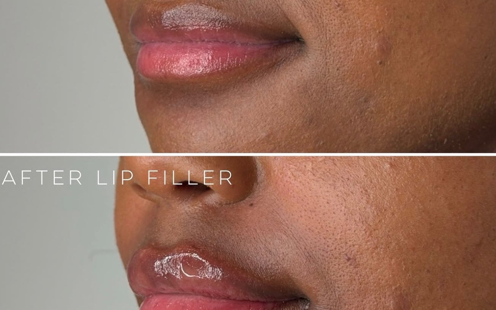 Dermal Fillers