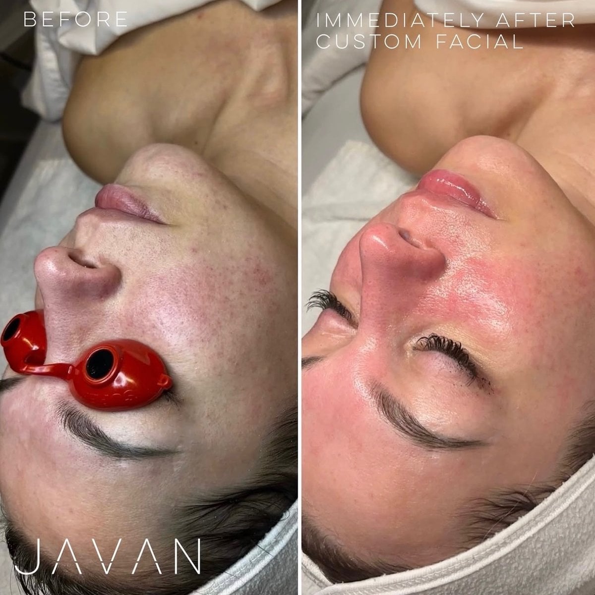 Dermaplane Facial
