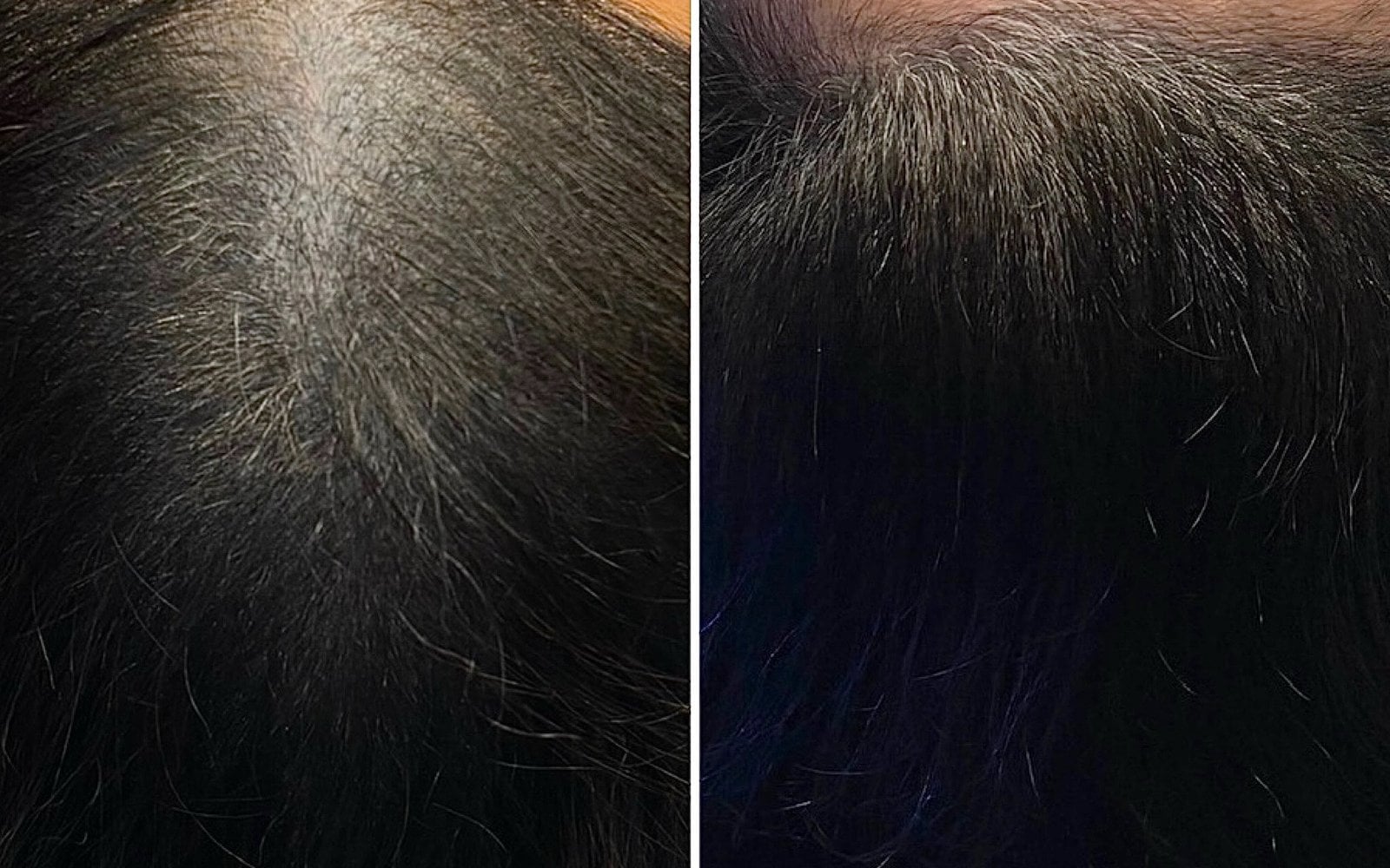 Hair Loss Treatments
