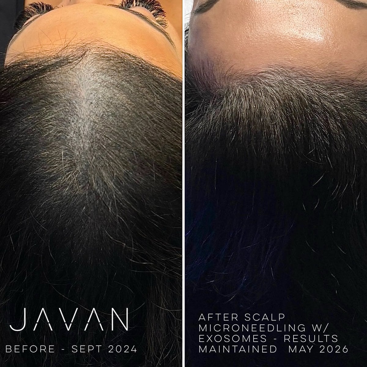 Hair Restoration