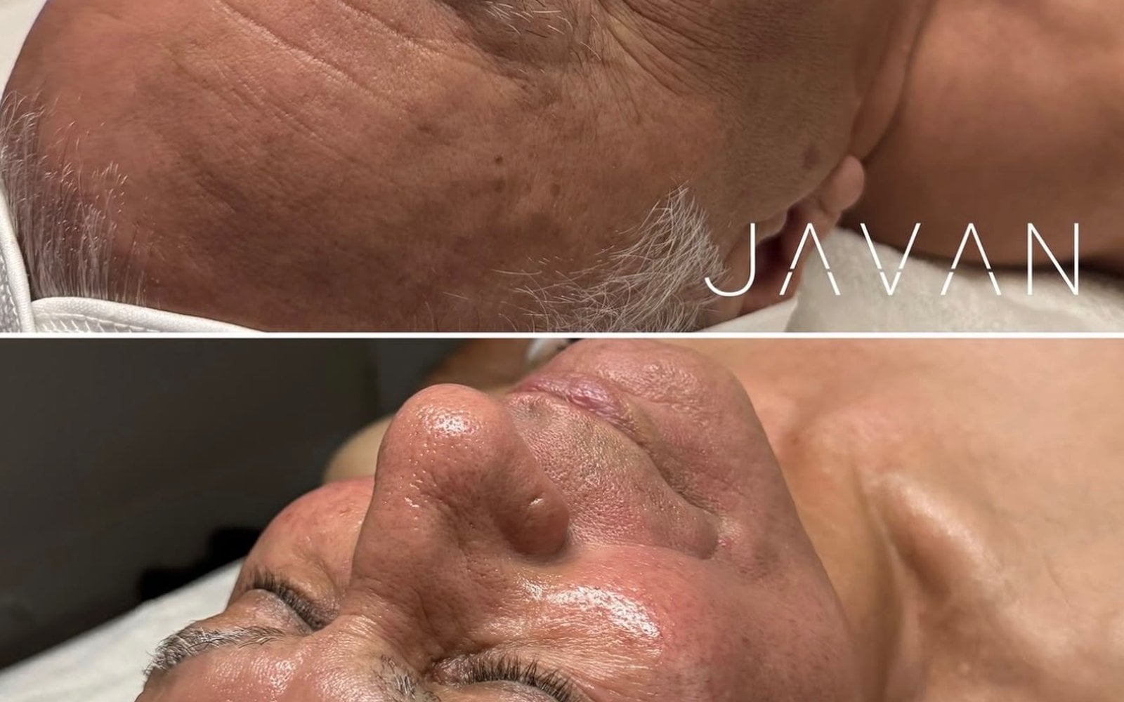 Hydrafacial Keravive Scalp Treatment