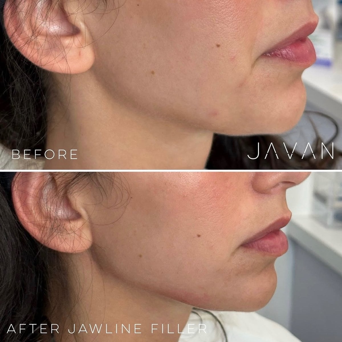 Jawline Filler