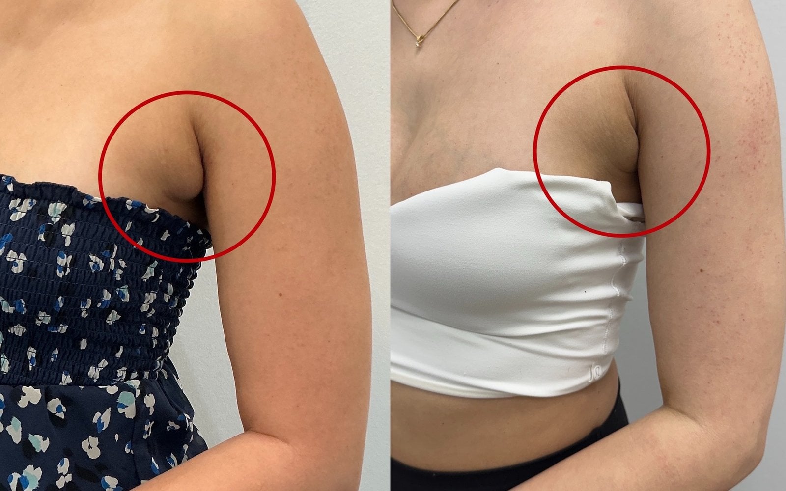 Kybella or Lipodissolve Injections
