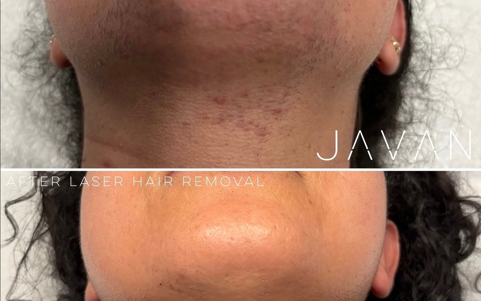 Laser Hair Removal at Javan Wellness