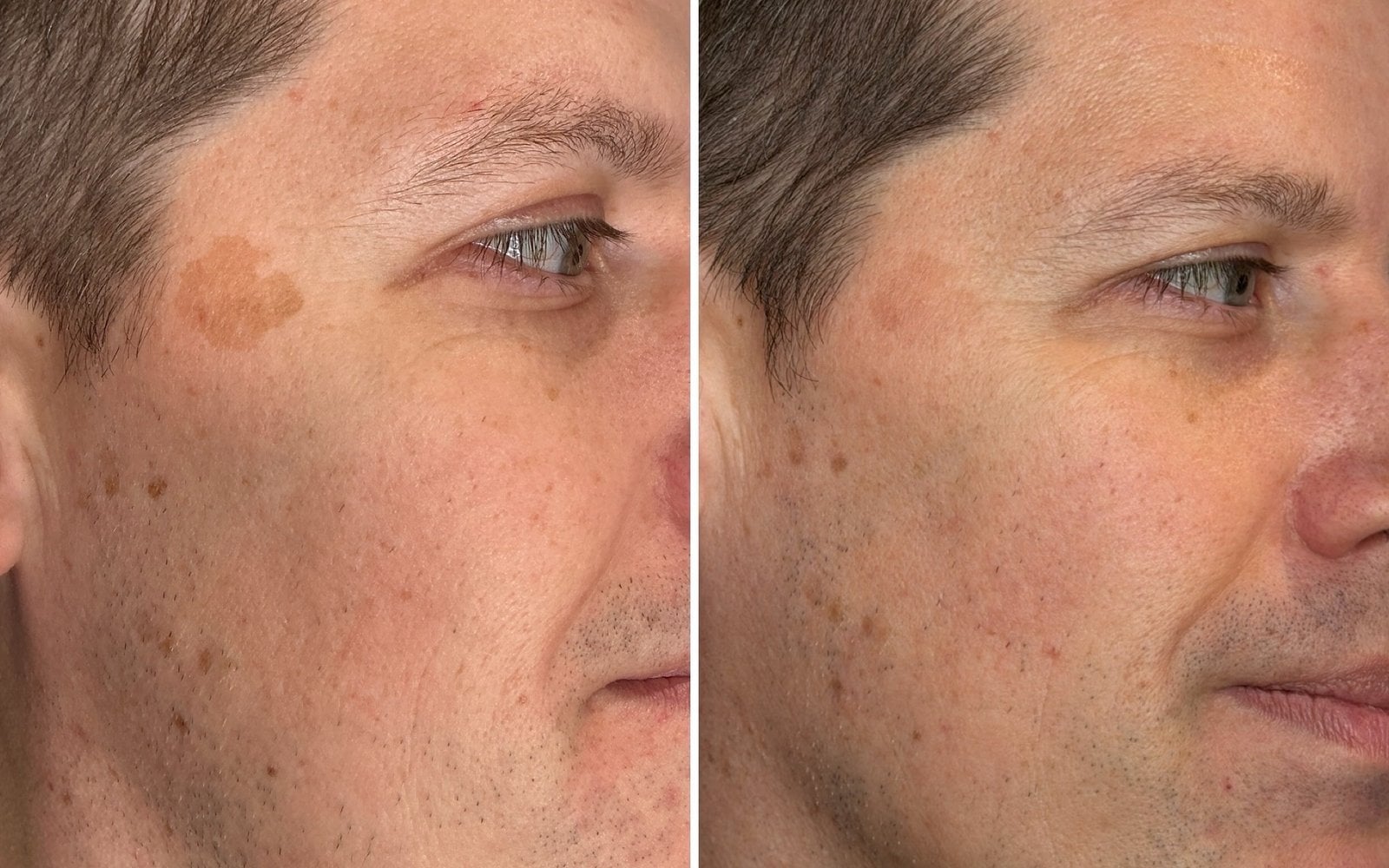 Laser Skin Rejuvenation