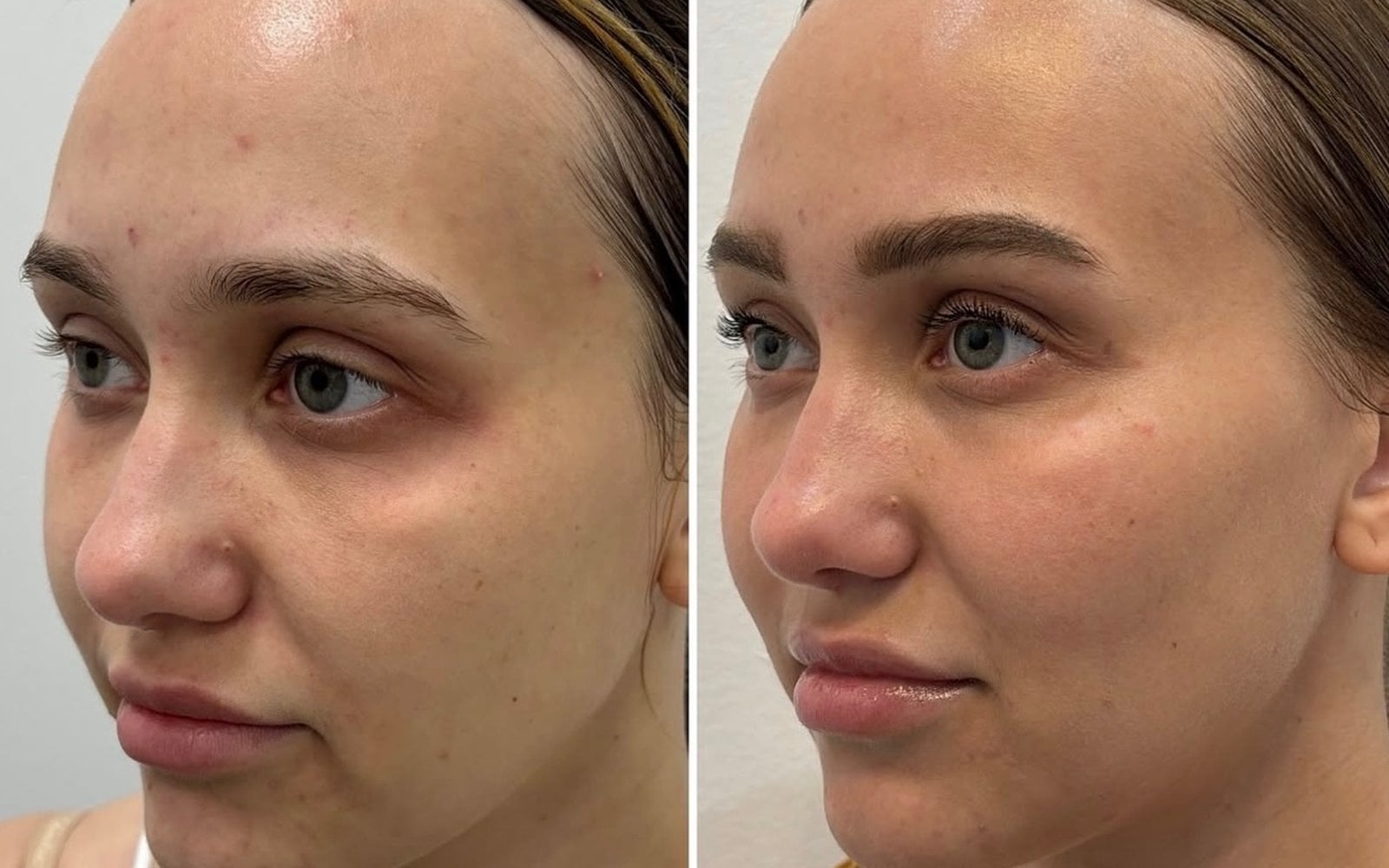 Liquid Gold Plasma Facial