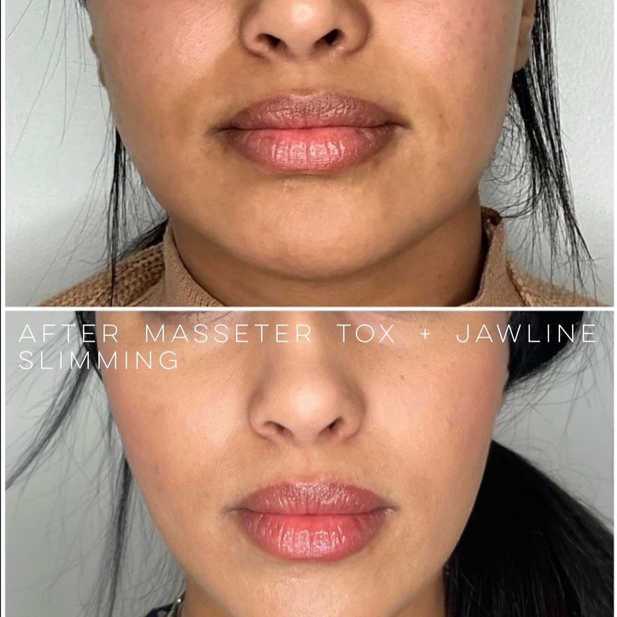 Masseter Tox
