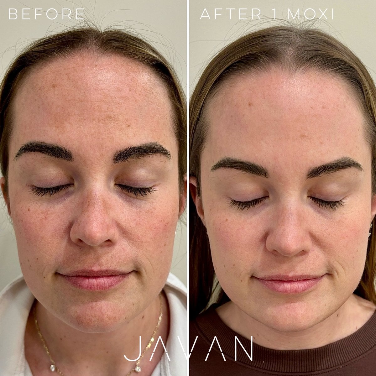 MOXI Resurfacing