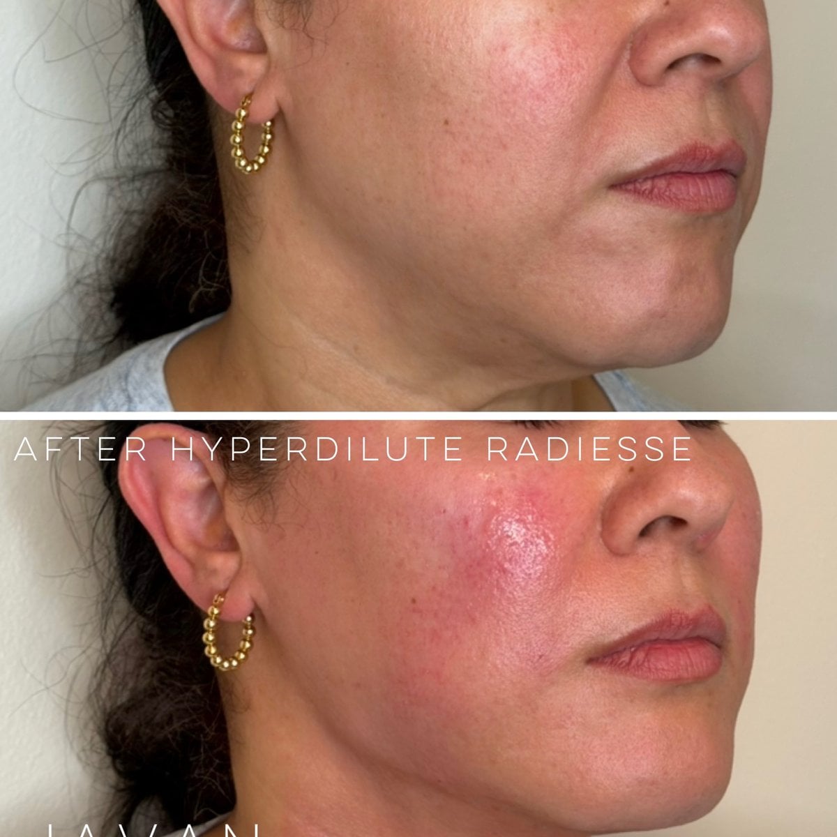 Radiesse Biostimulator