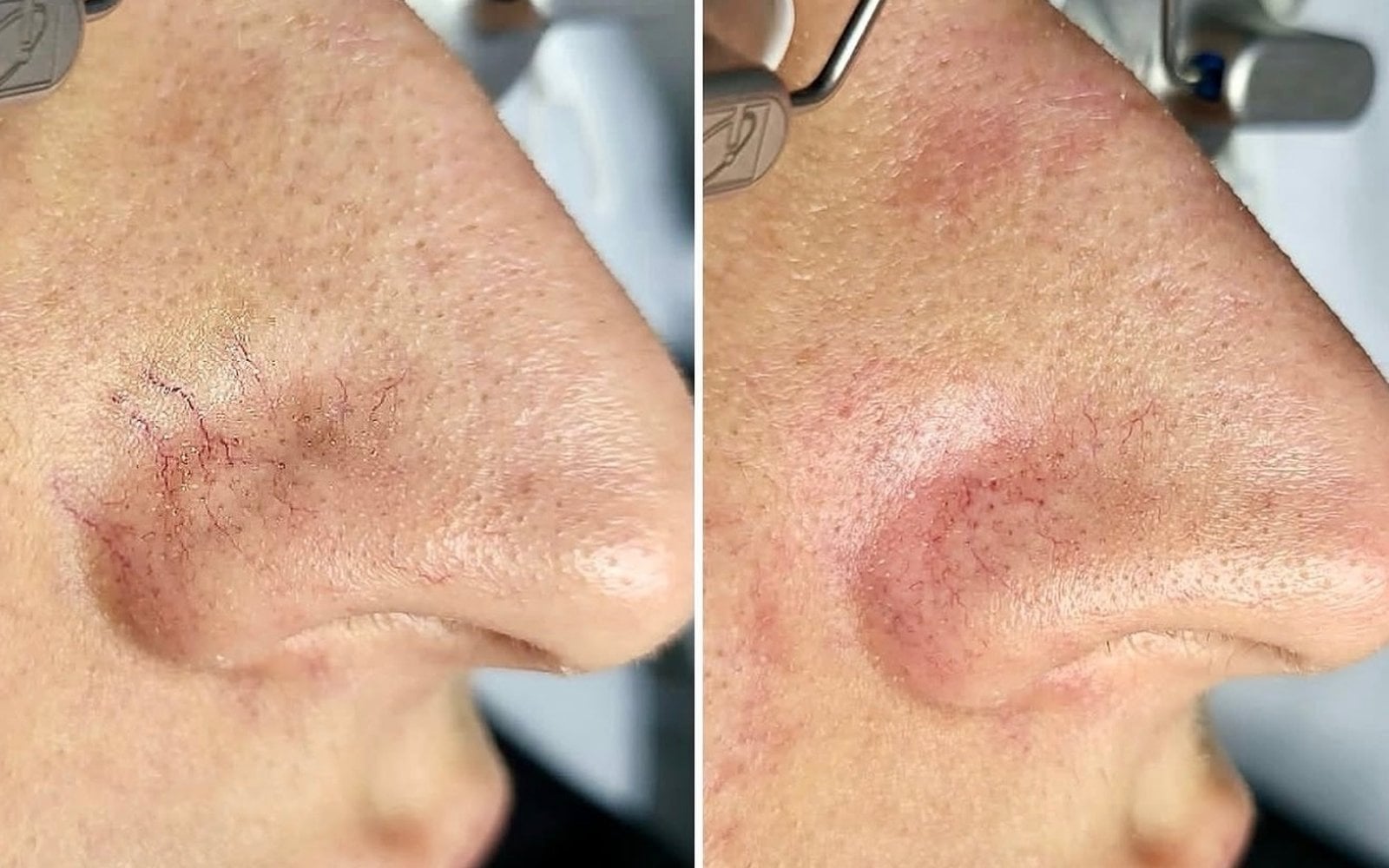 Vein Treatment