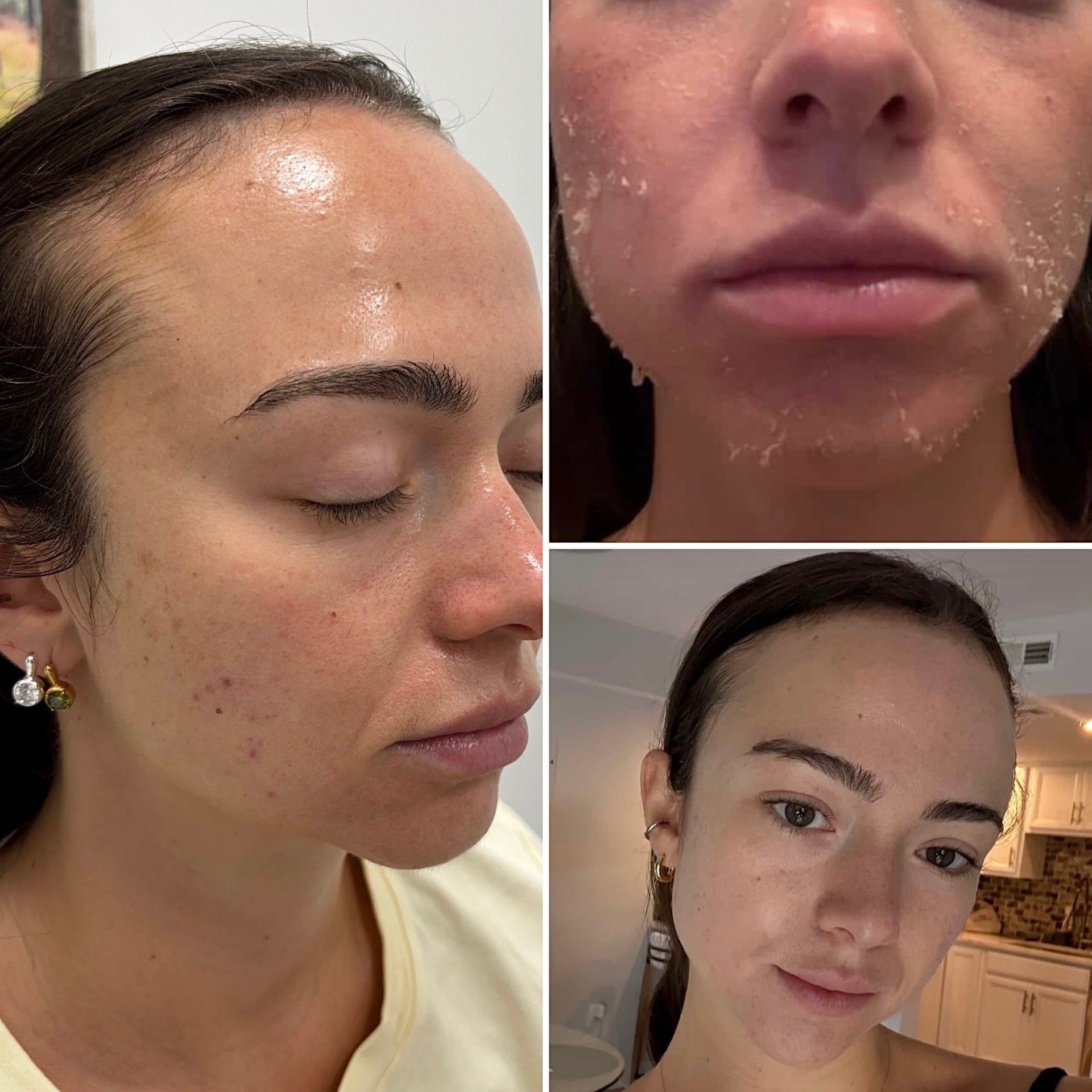 Liquid Gold Plasma Facial / PRF EZ Gel