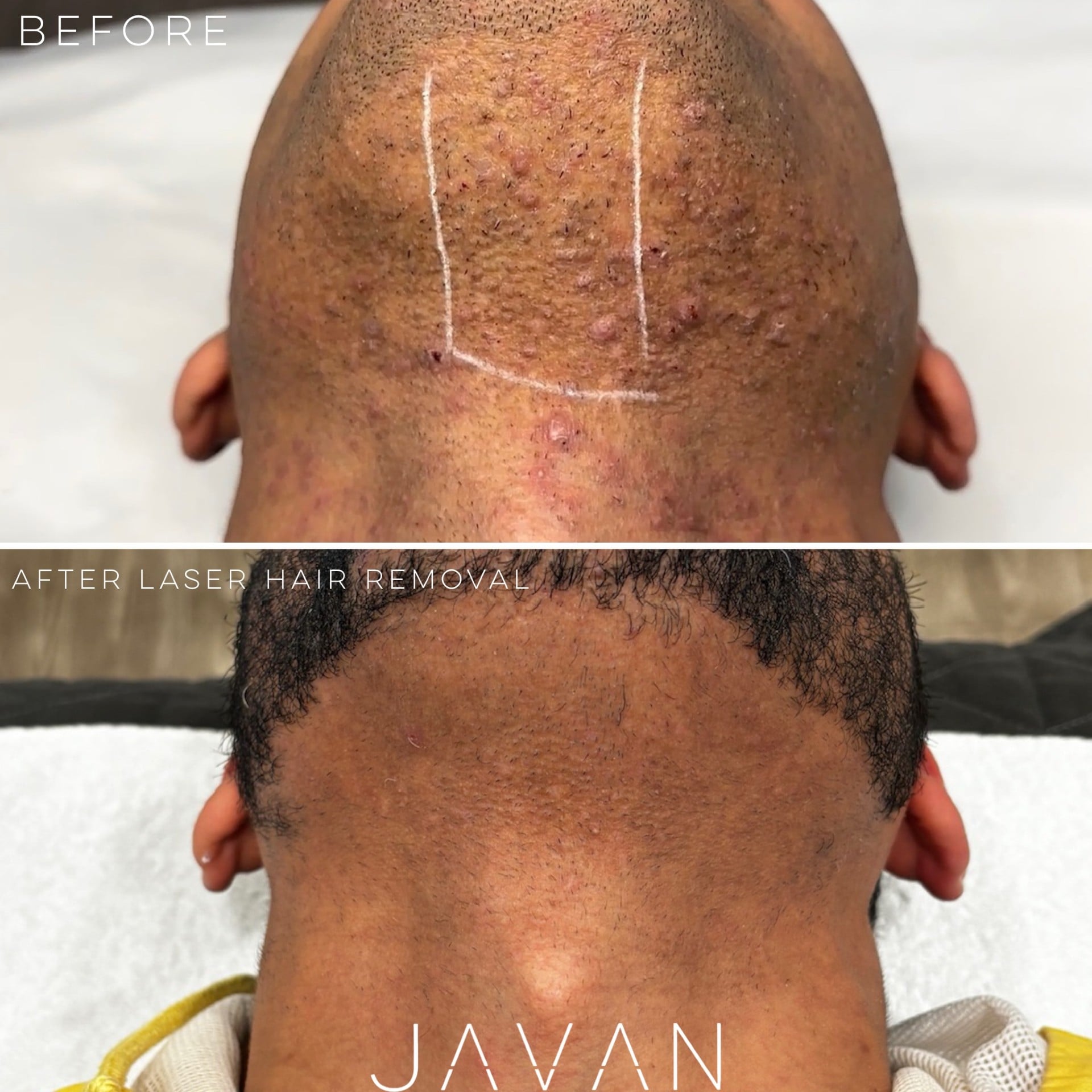 Laser Hair Removal