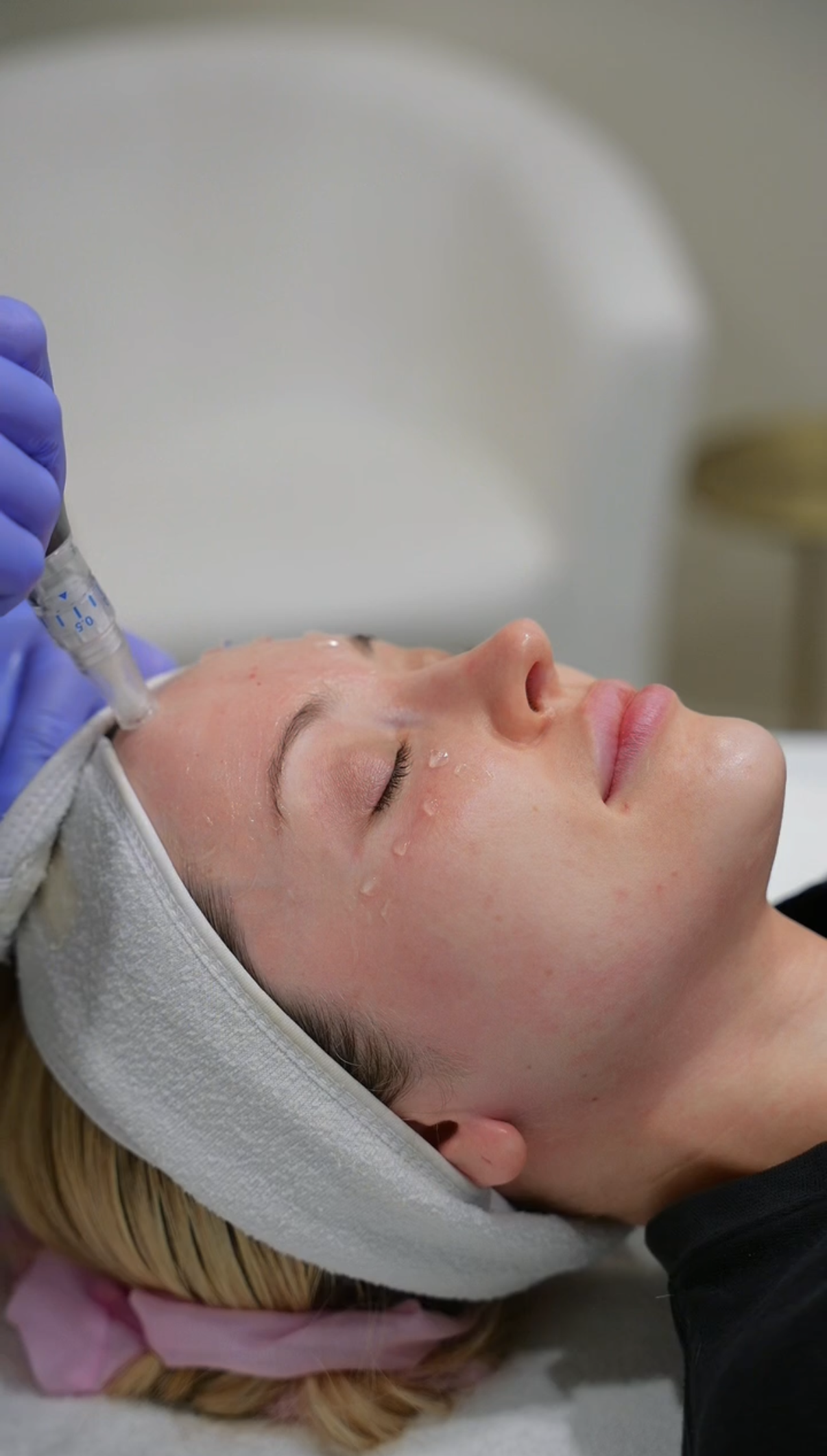 SkinPen Microneedling