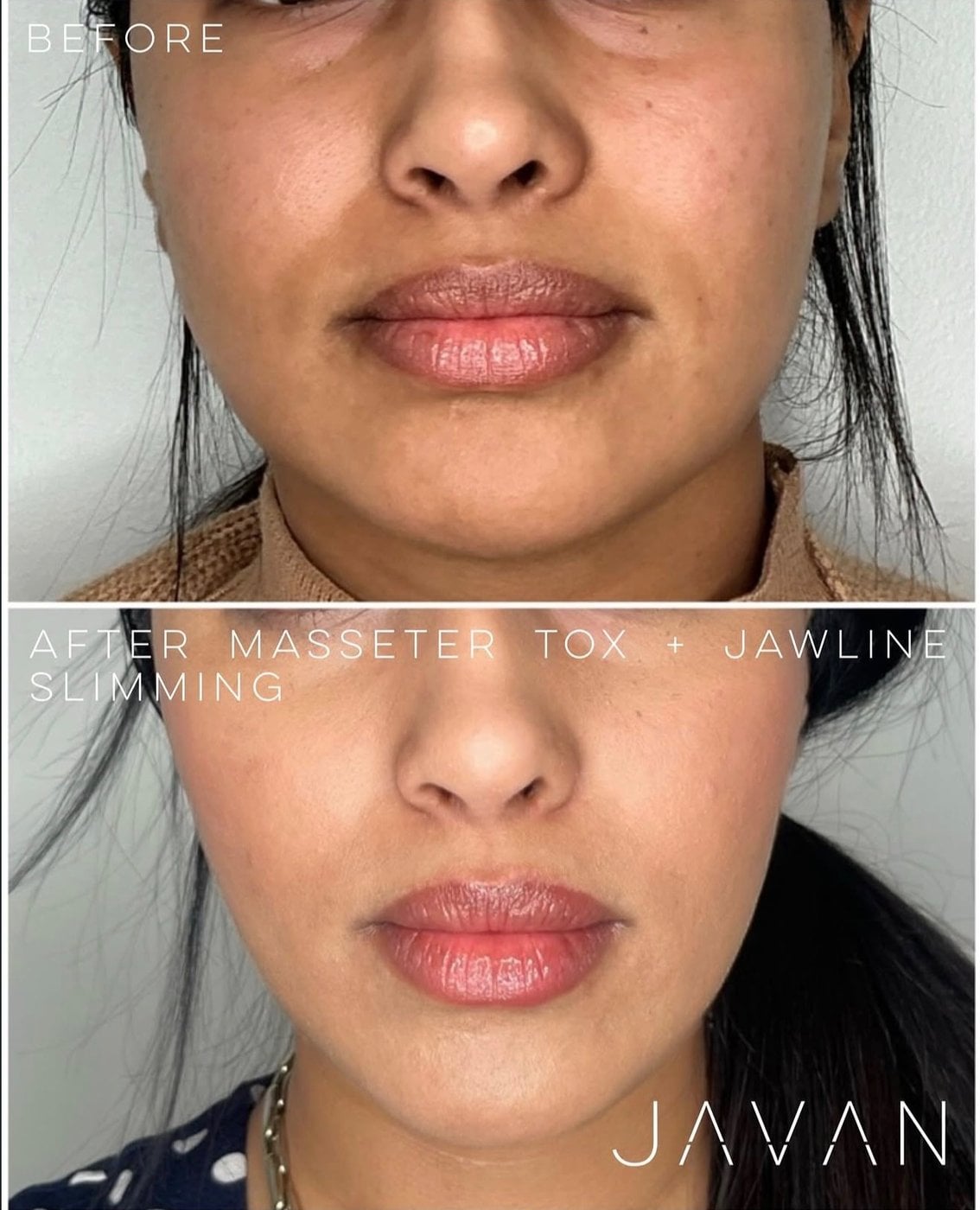 Masseter Tox and jawline slimming before and after