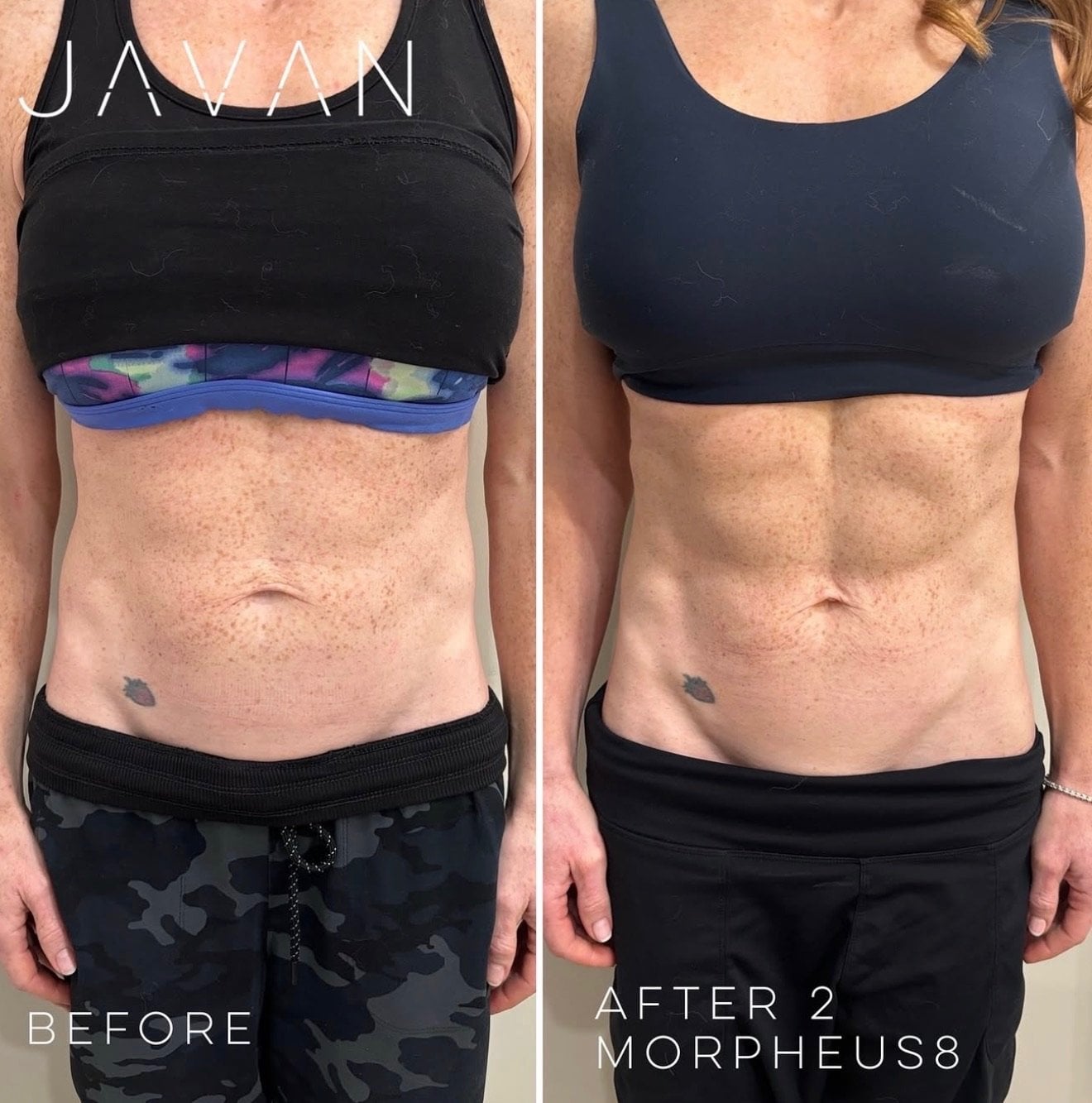 Morpheus8 — Body at Javan Wellness
