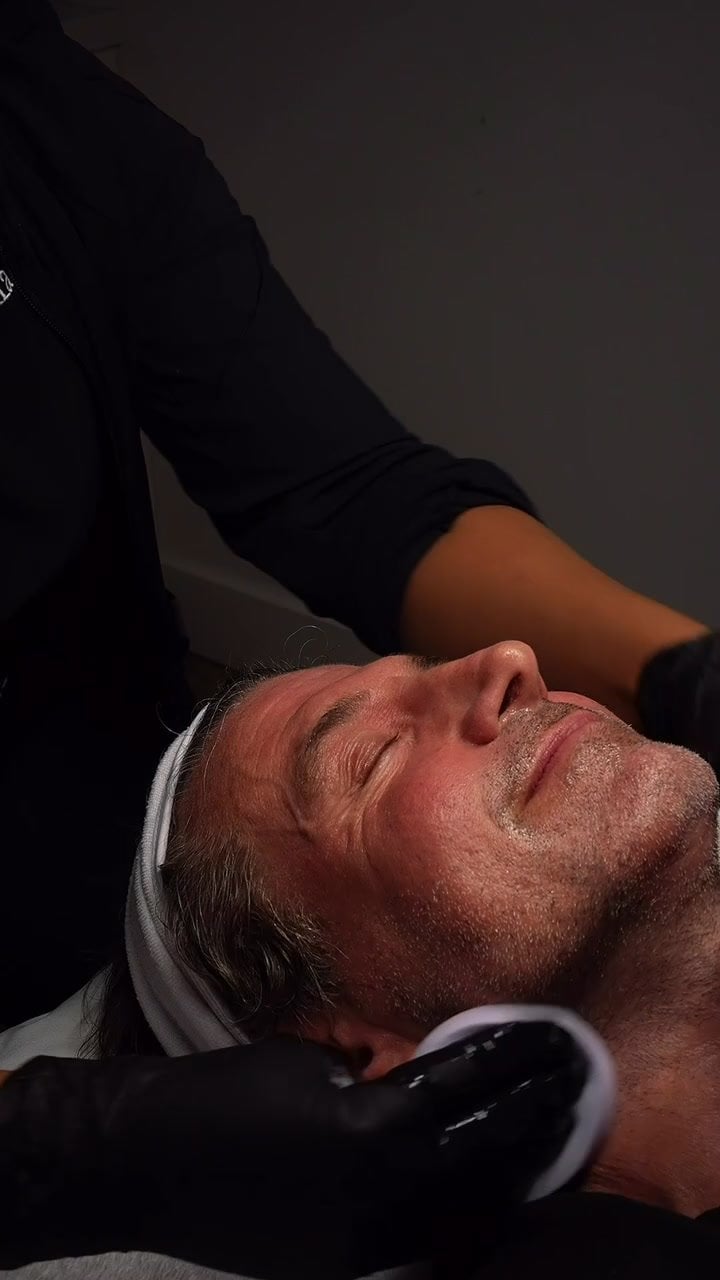 SkinPen Microneedling