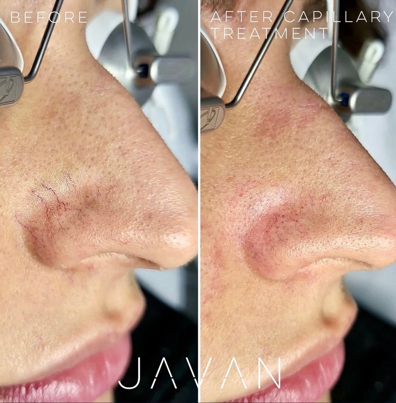 Vein Treatment