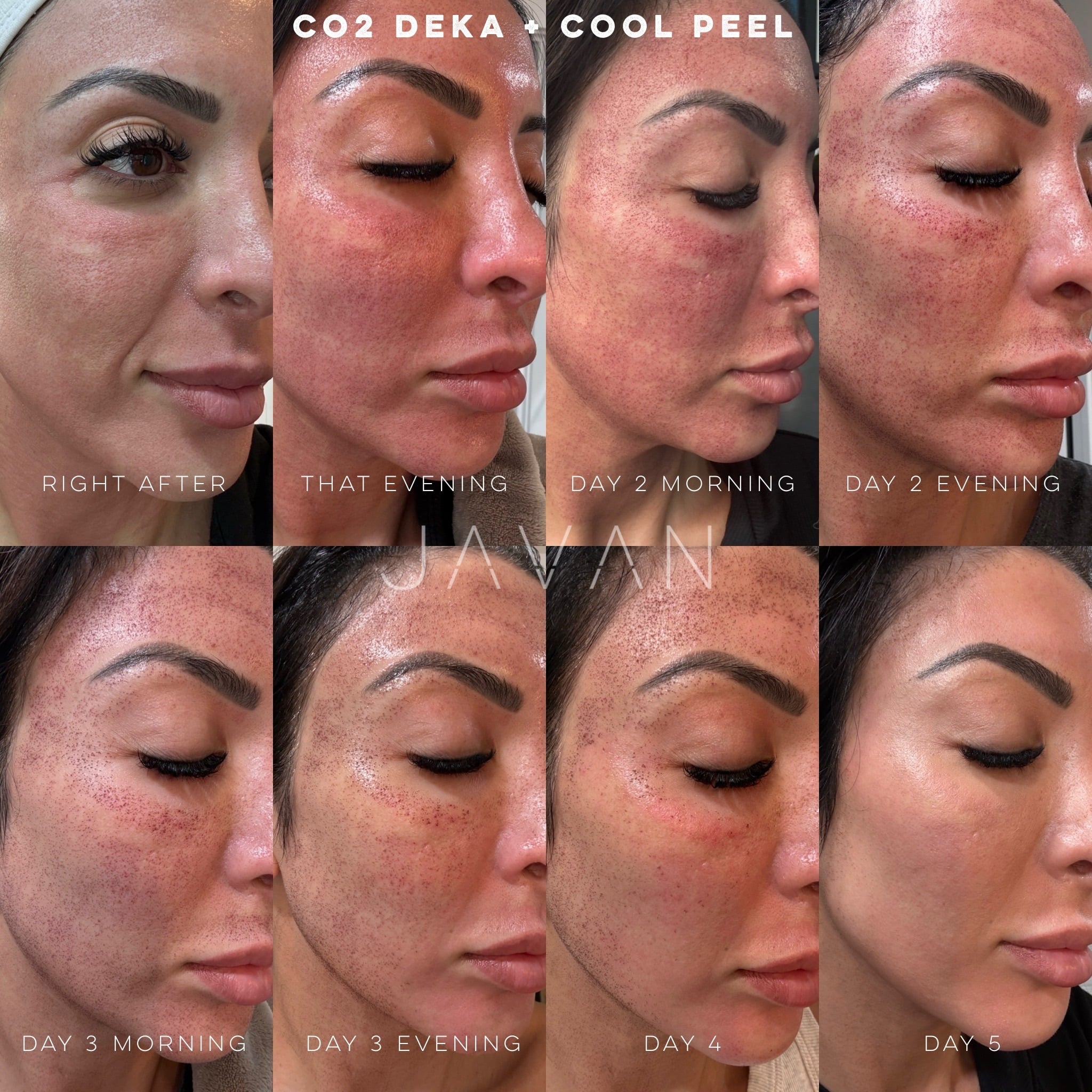 CO2 Laser Resurfacing at Javan Wellness