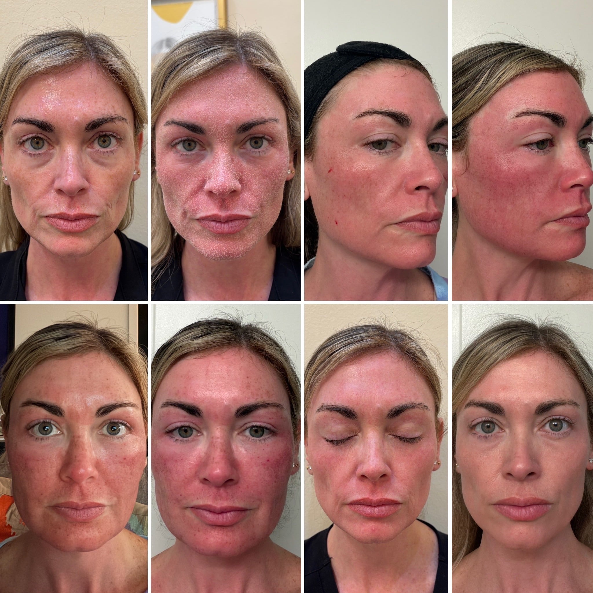CO2 Laser Resurfacing at Javan Wellness