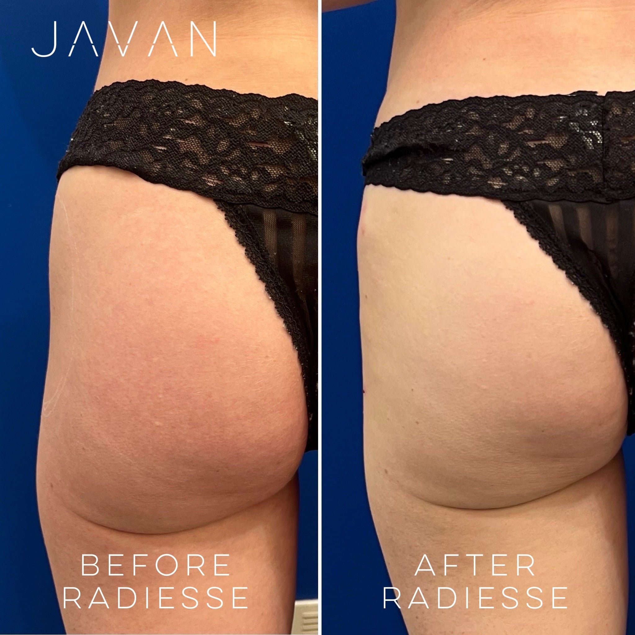 Radiesse Biostimulator at Javan Wellness