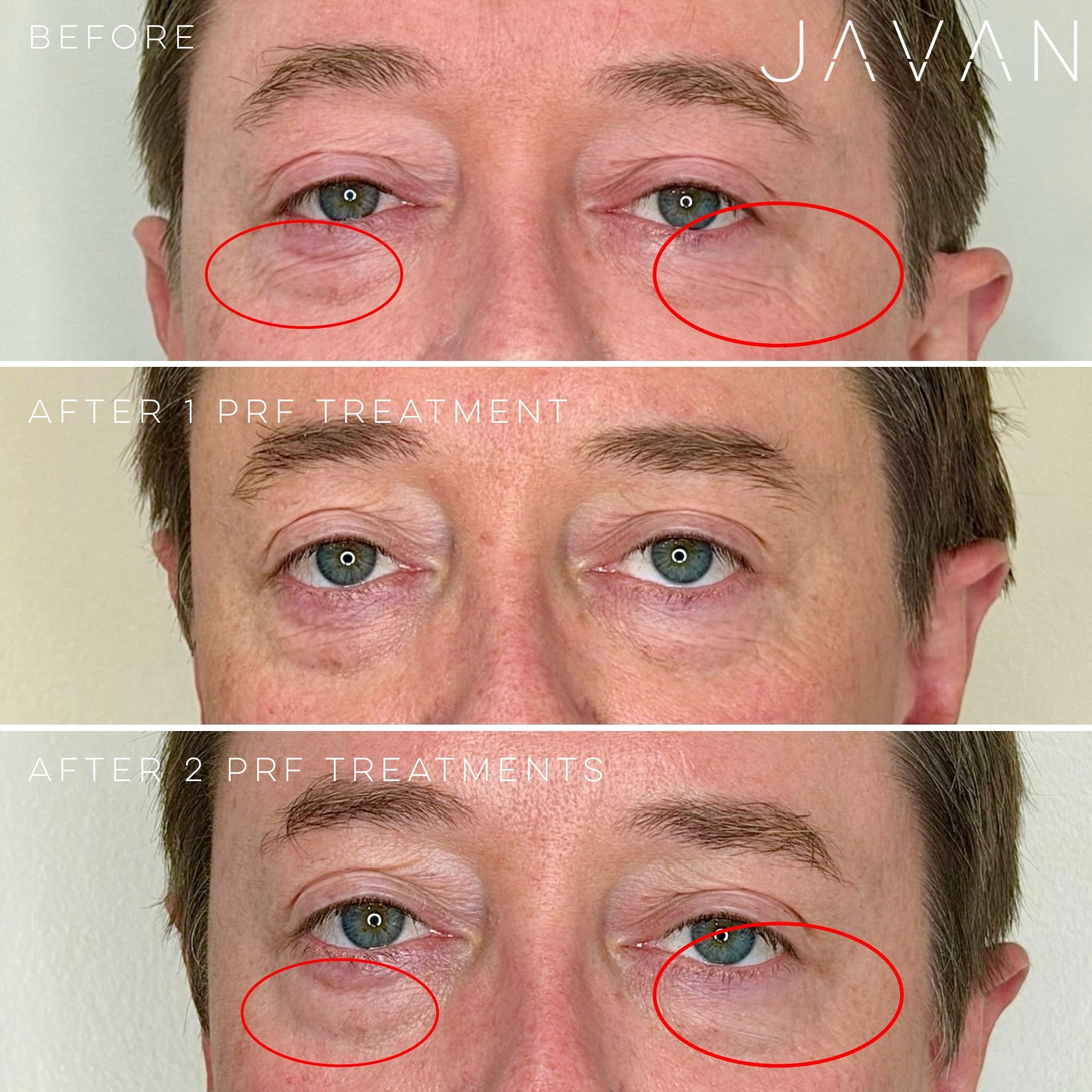 PRF Platelet-Rich Fibrin treatment at Javan Wellness