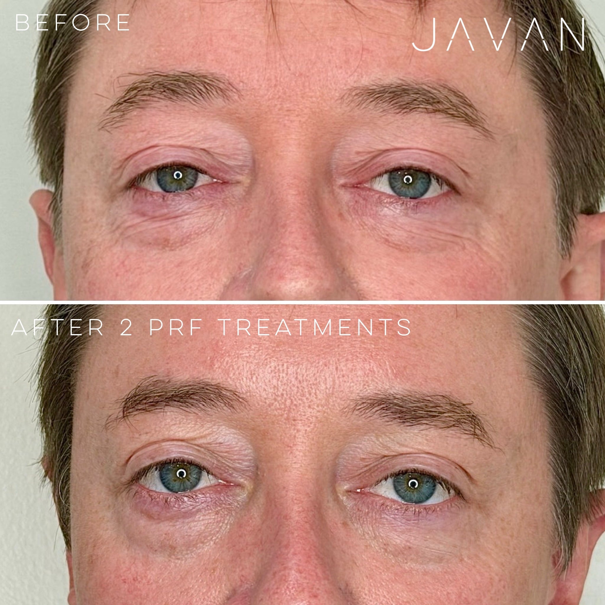 PRF Platelet-Rich Fibrin treatment at Javan Wellness