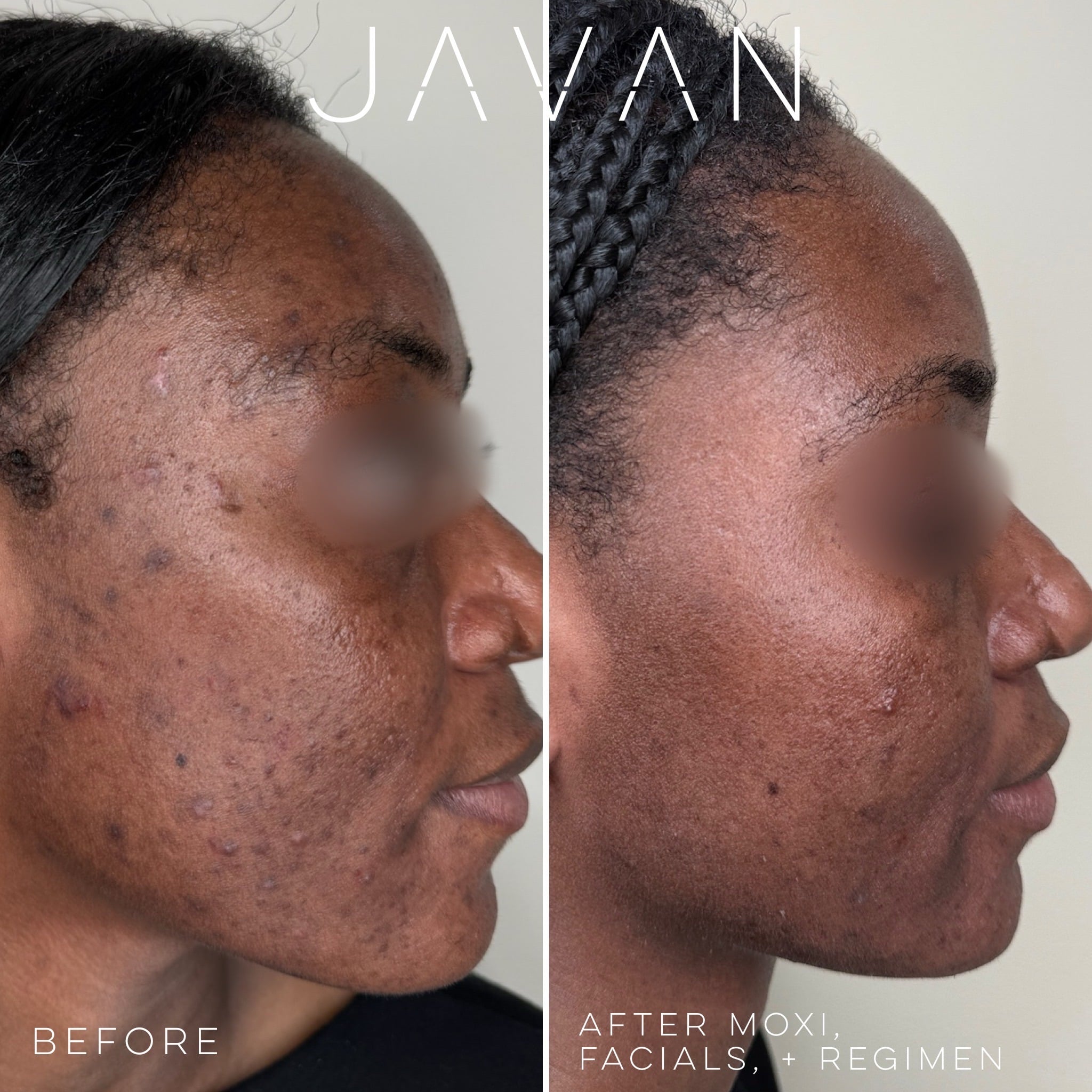 Moxi laser resurfacing at Javan Wellness