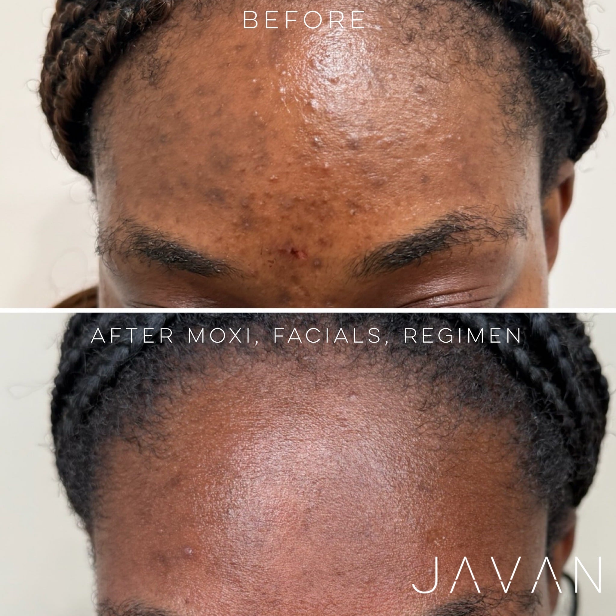 Moxi laser resurfacing at Javan Wellness
