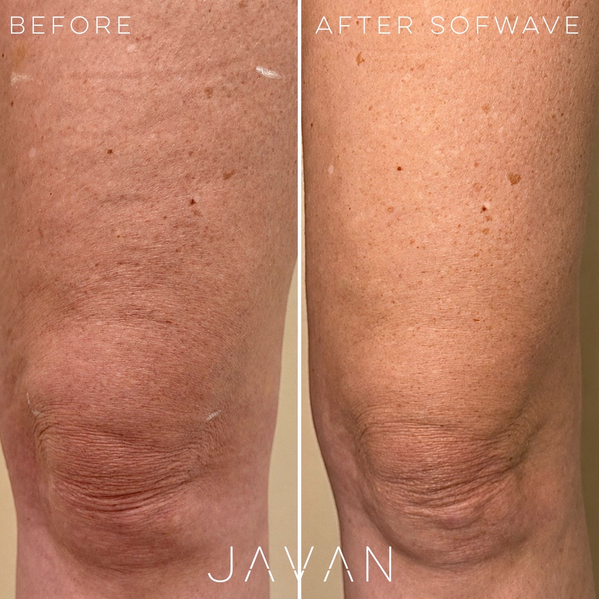 Sofwave Body skin tightening at Javan Wellness Before and After