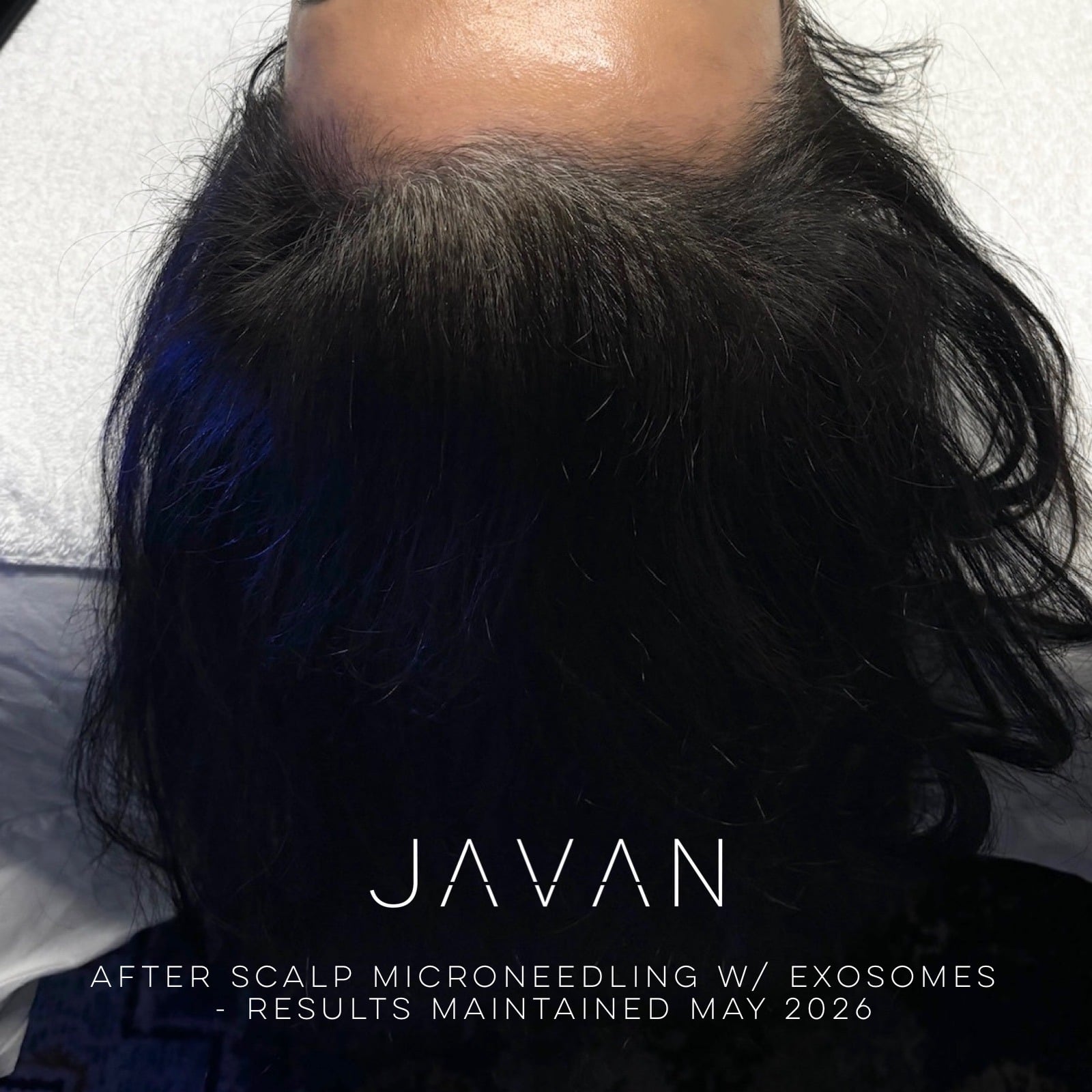 Hair Restoration