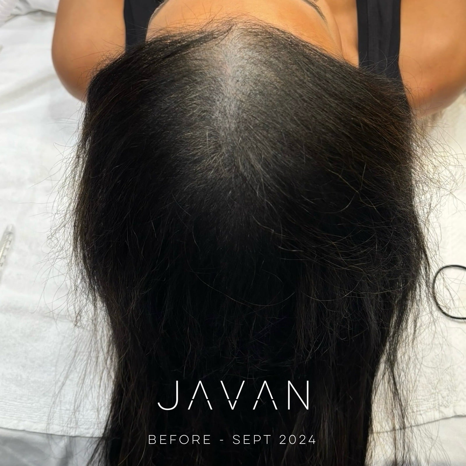 Hair Restoration