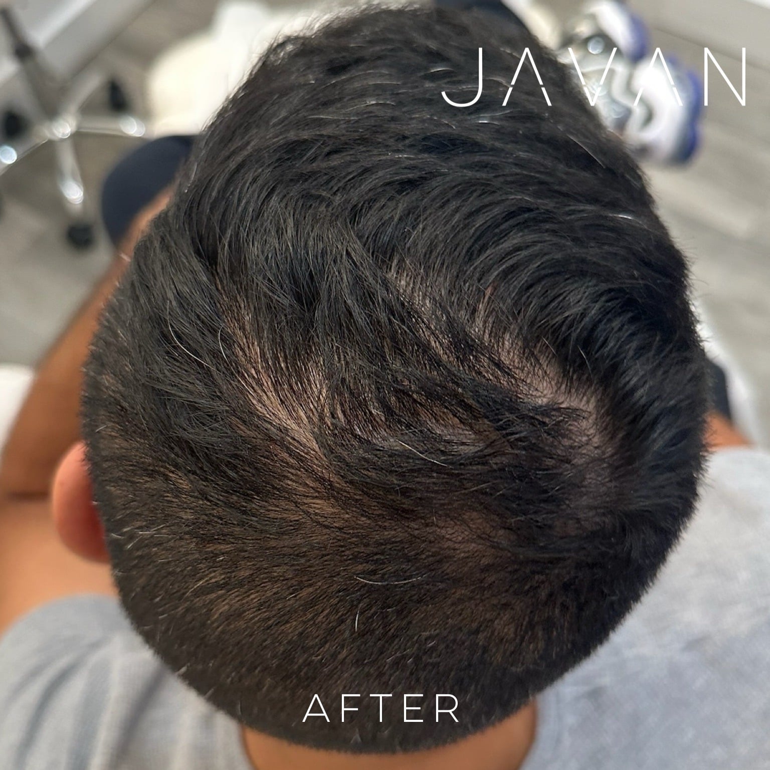 Hair Restoration Male After