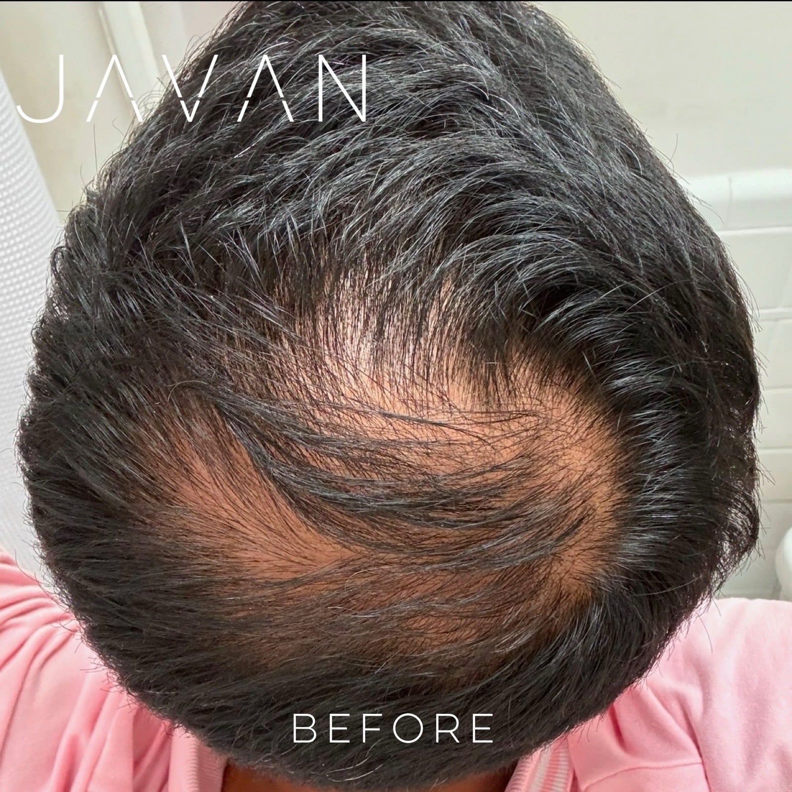 Hair Restoration Male Before