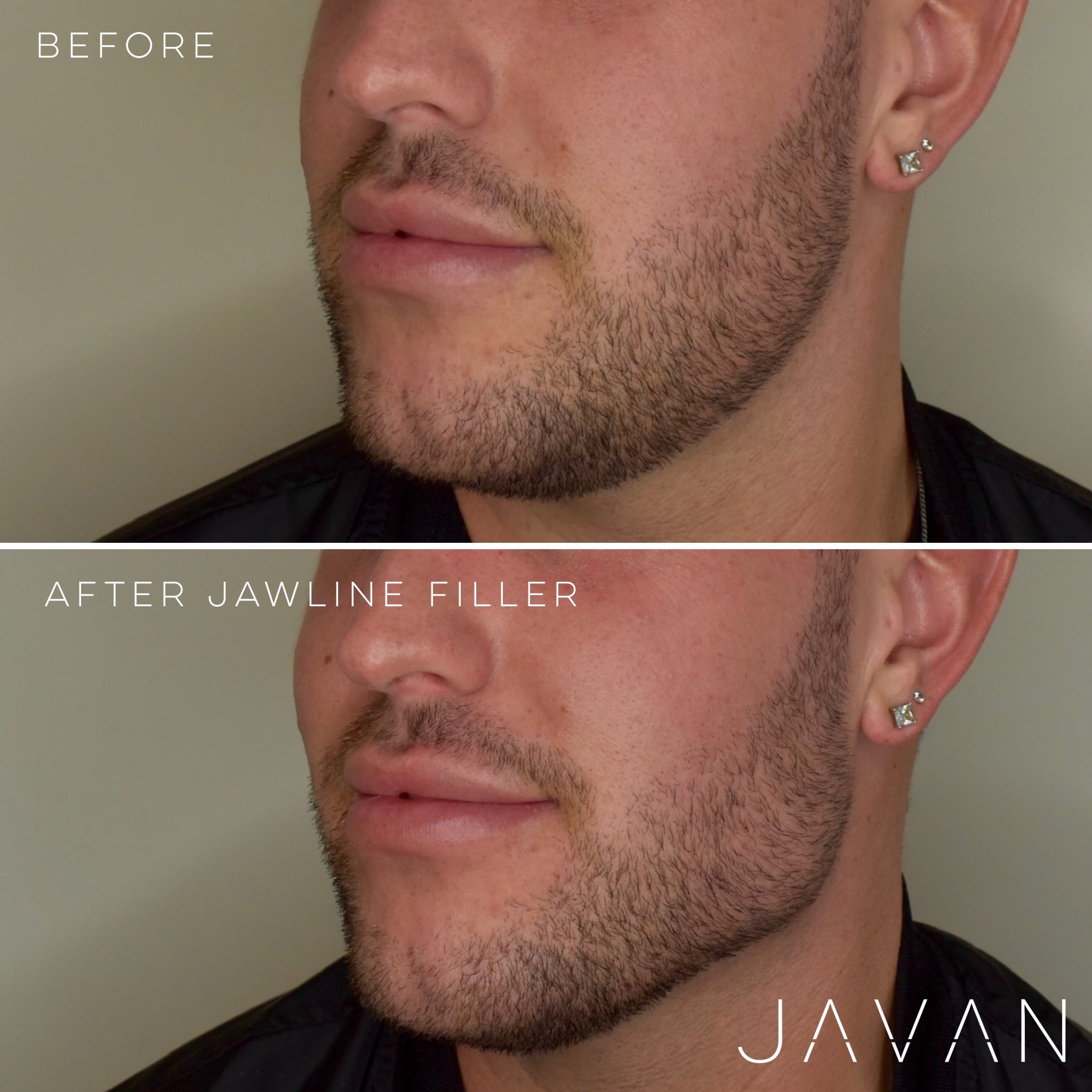 Jawline filler before and after