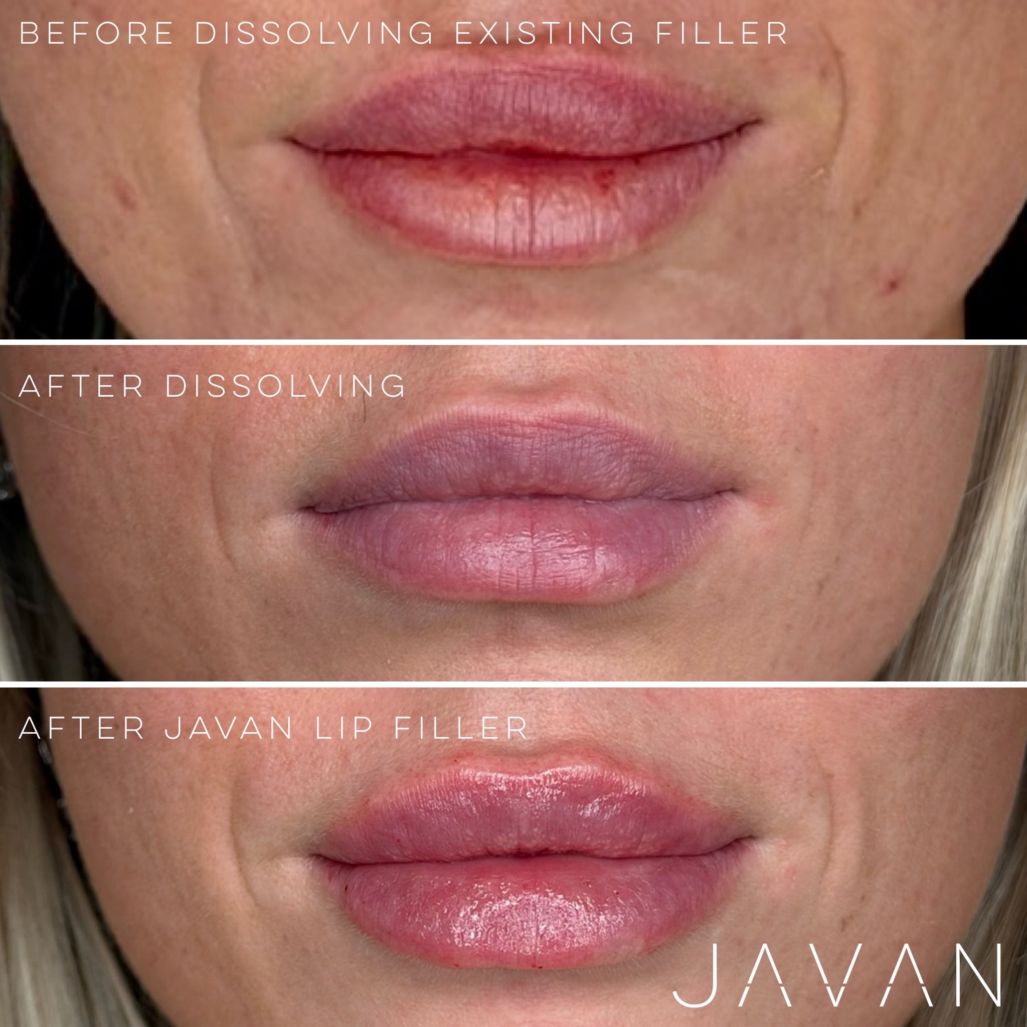 Lip filler before and after
