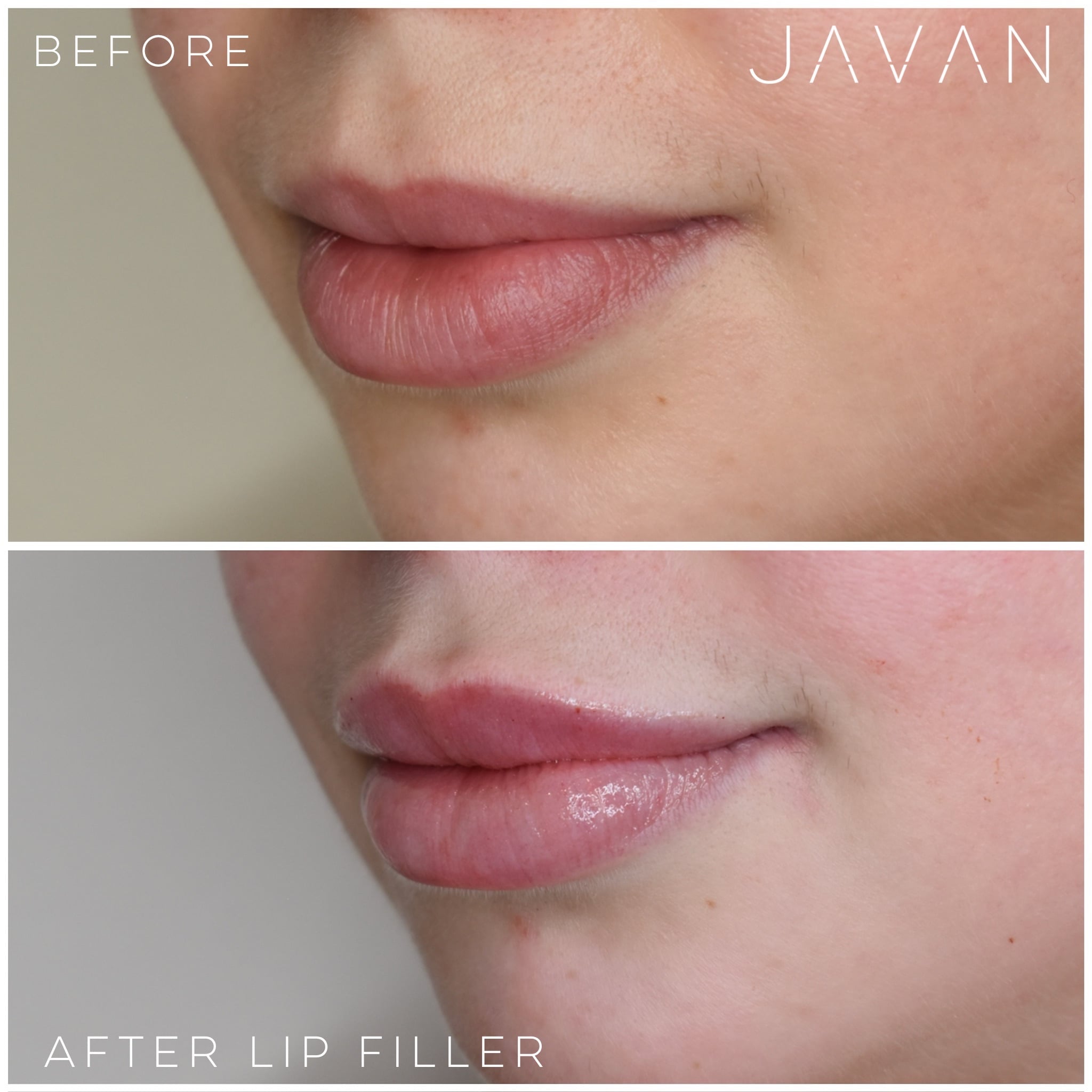Lip filler result