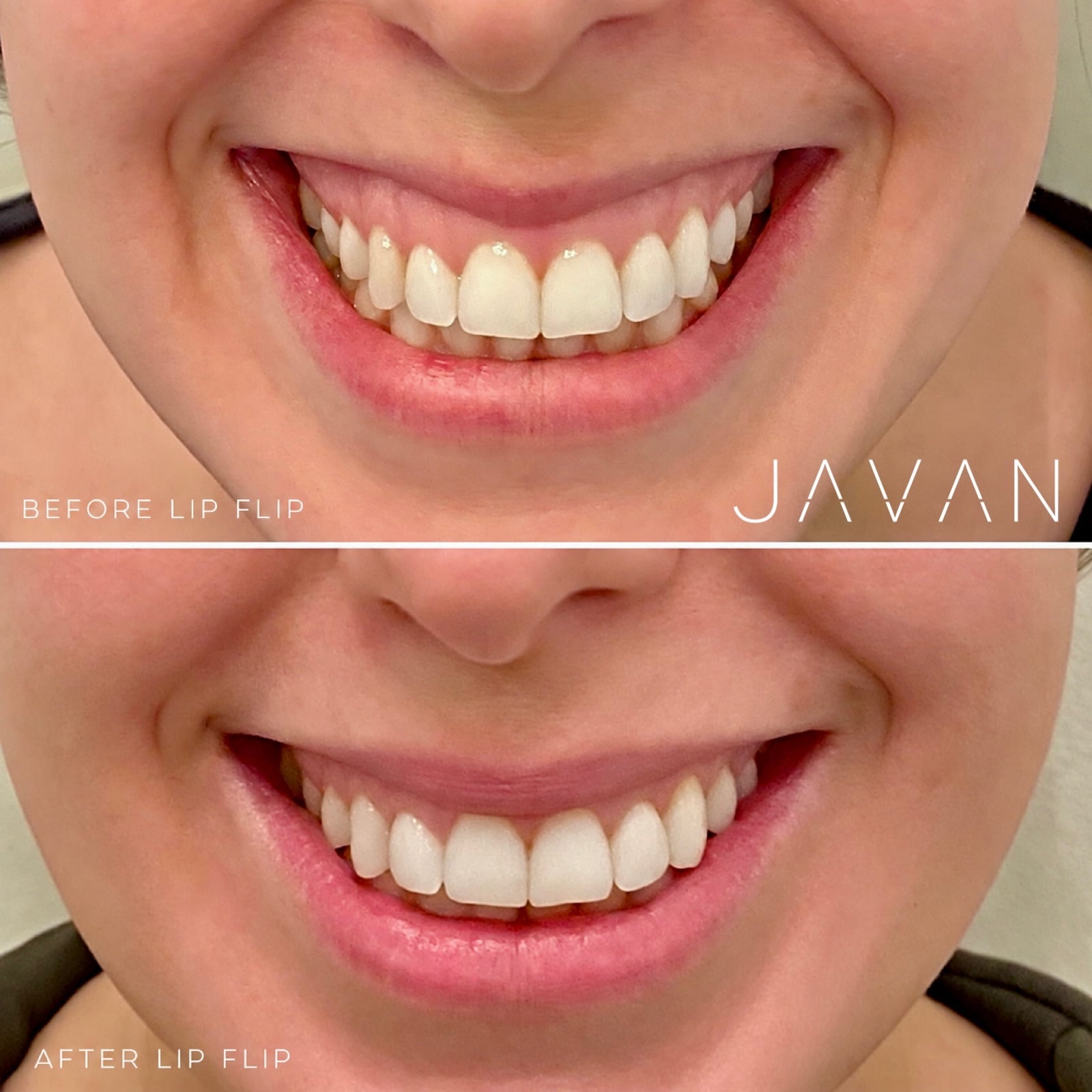 Lip Flip / Microtox