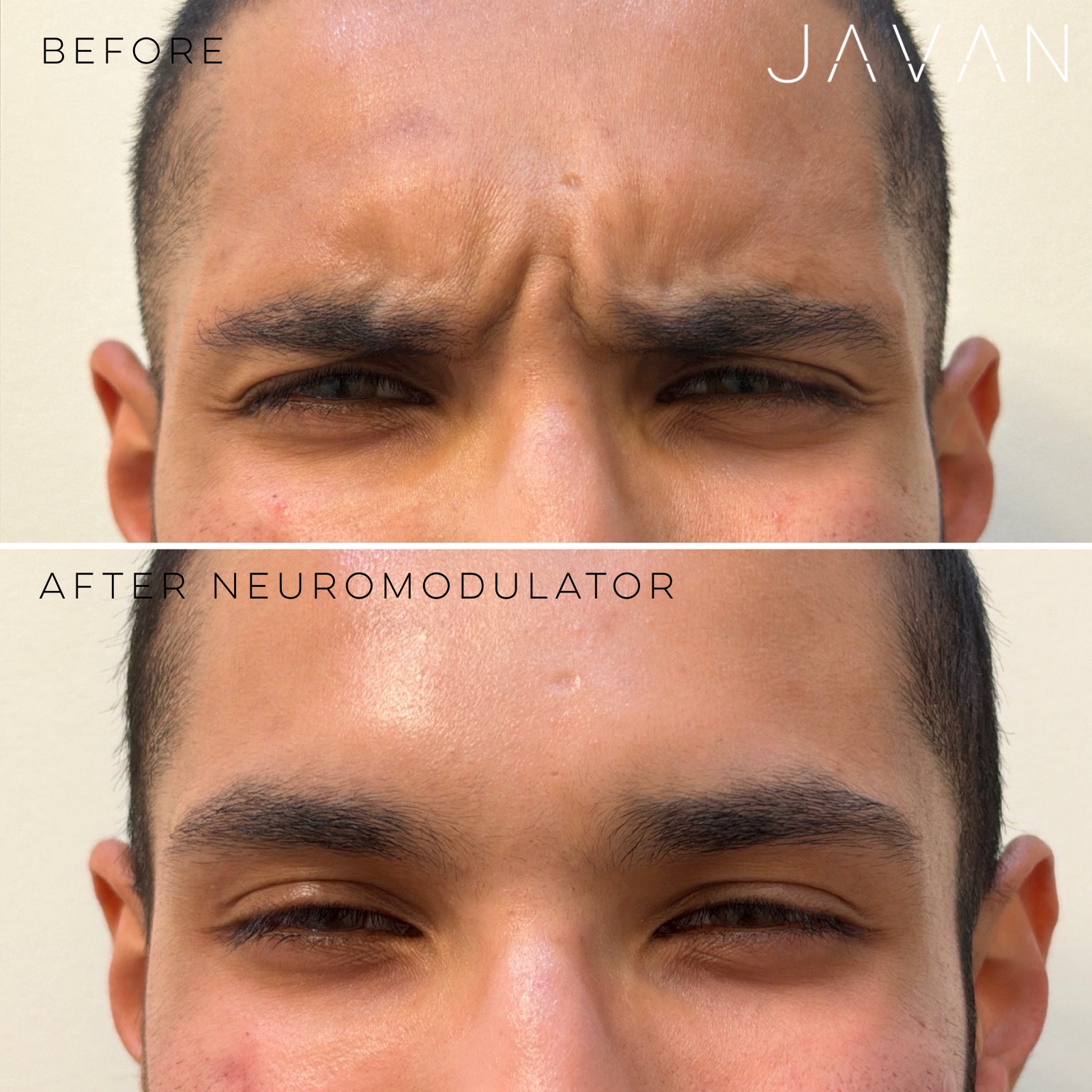 Male forehead neuromodulator result