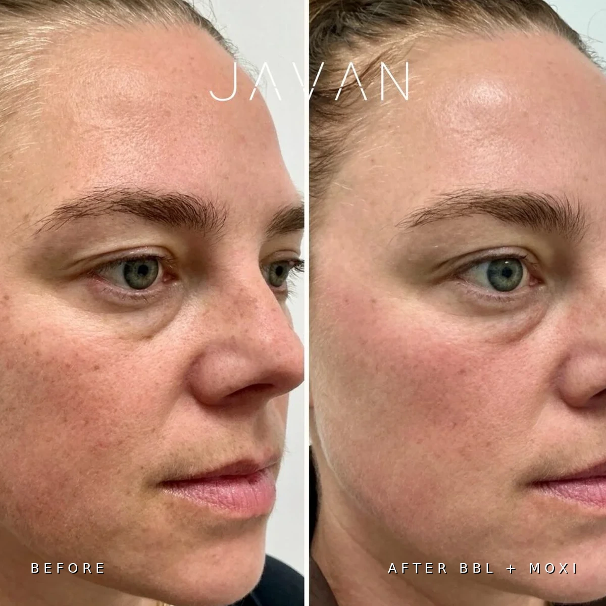 BBL and MOXI laser before and after