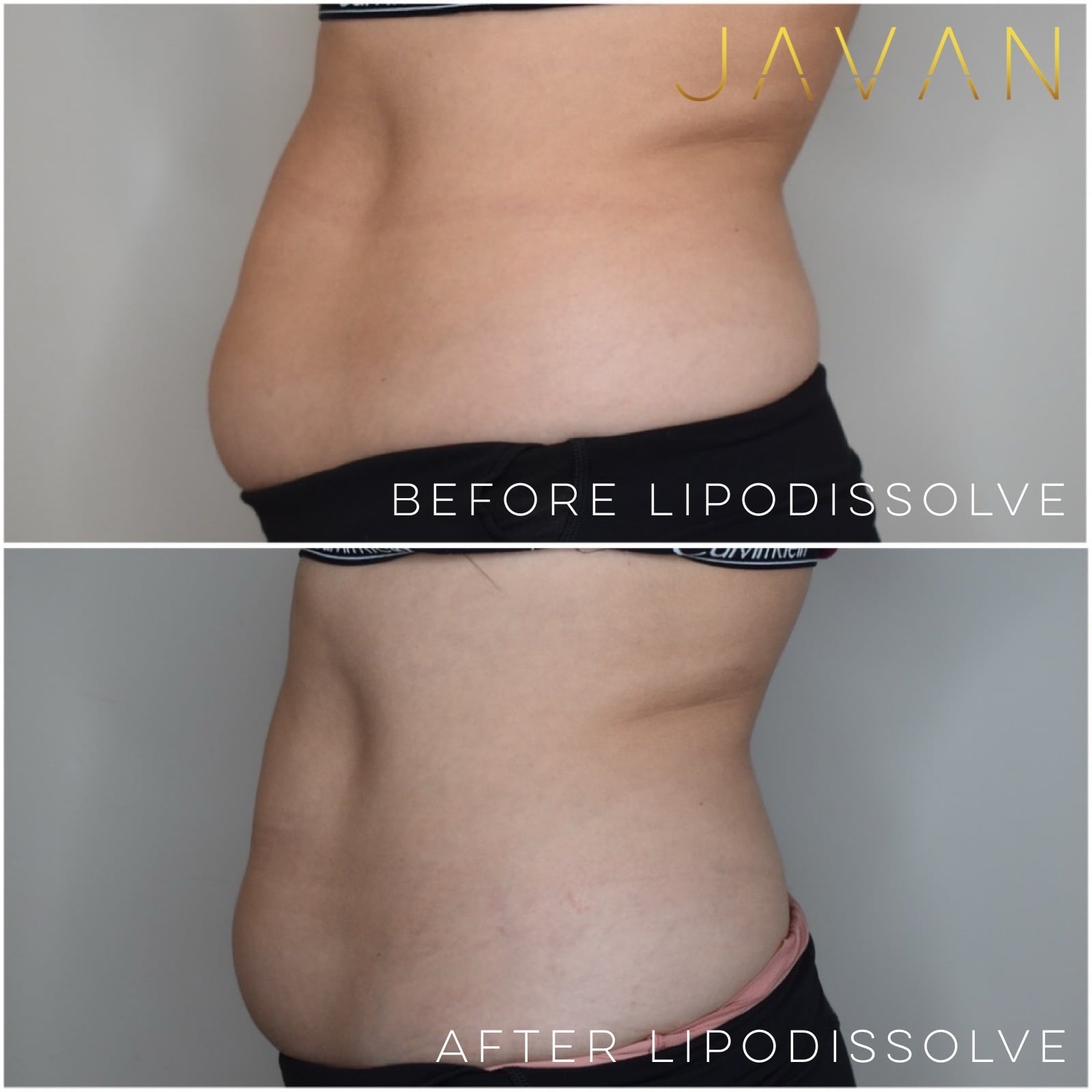 Kybella / Lipodissolve