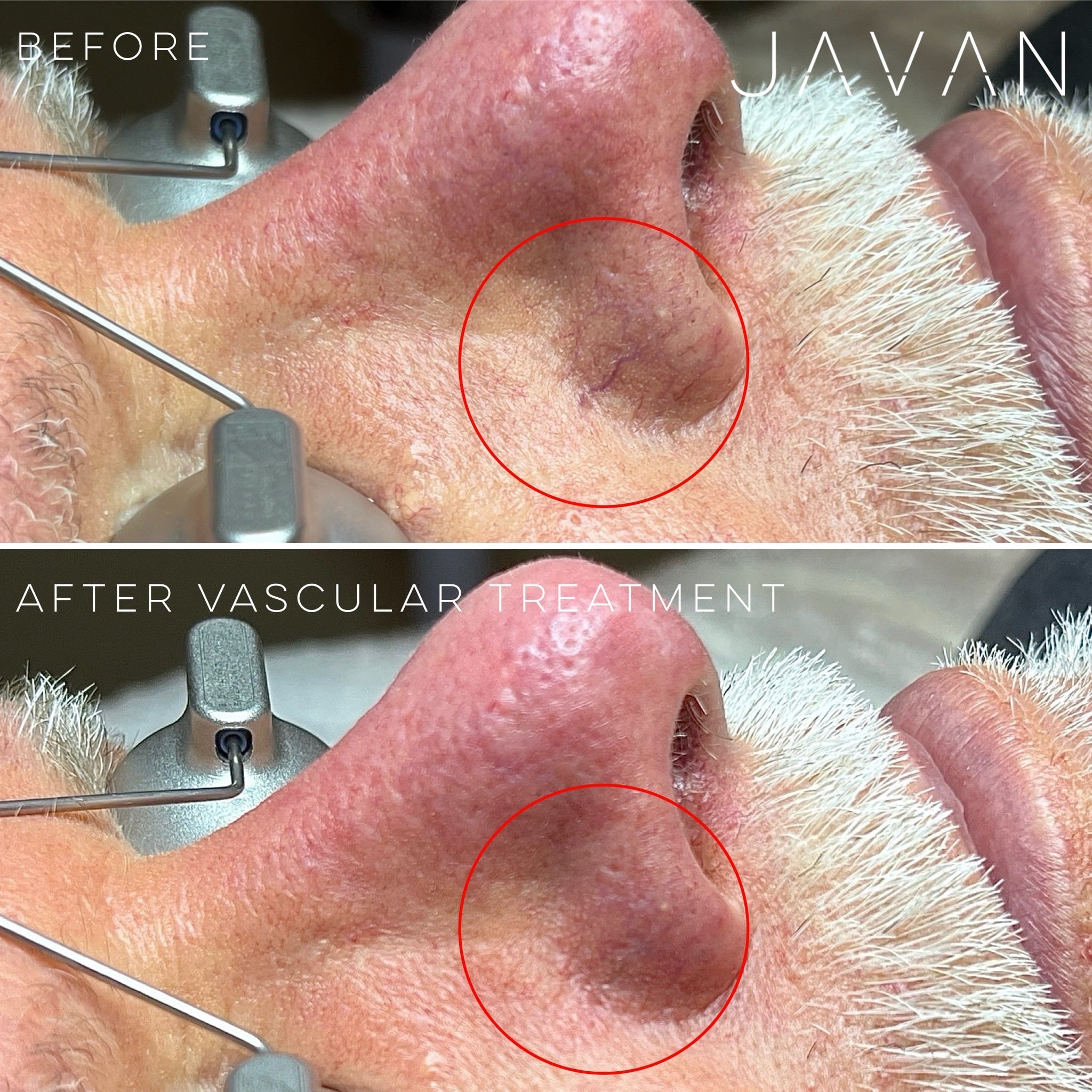 Laser Skin Rejuvenation