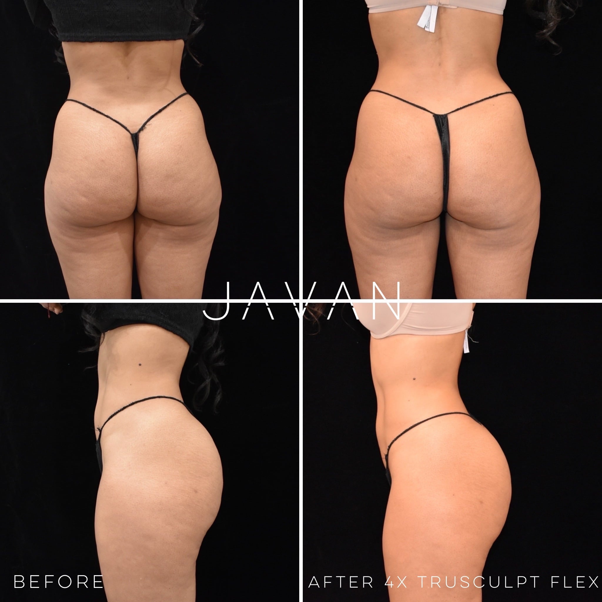 Trusculpt Flex at Javan Wellness