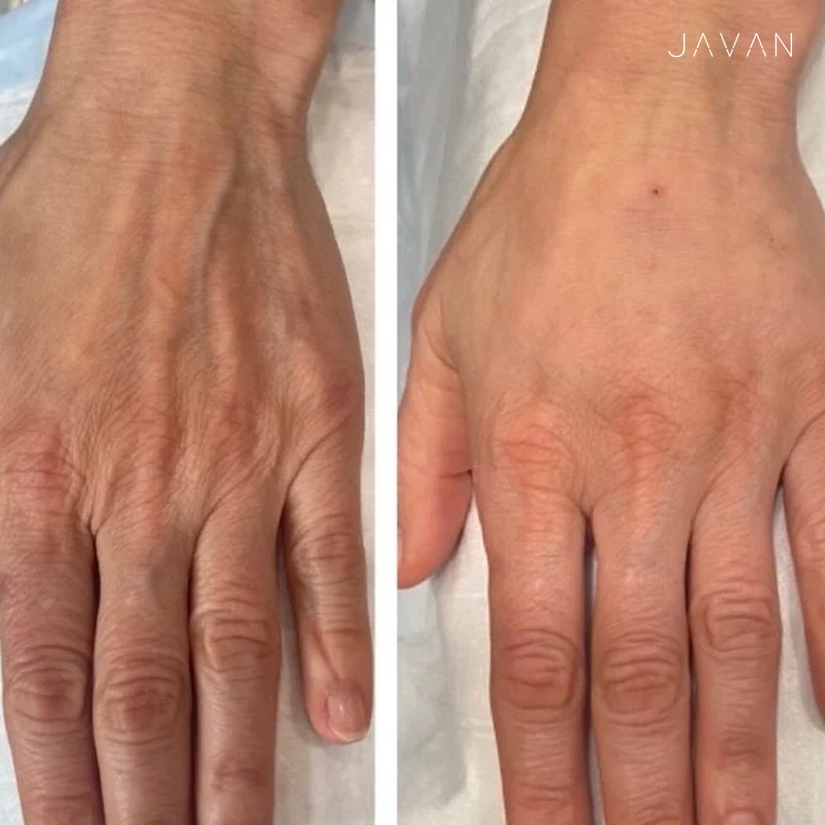Hand rejuvenation before and after