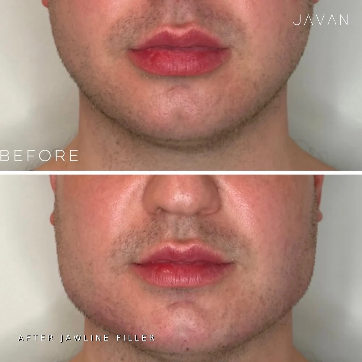 Jawline filler before and after