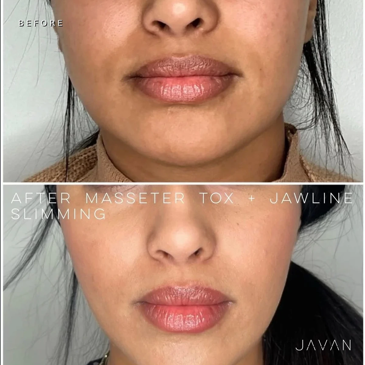 Masseter Tox before and after